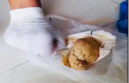 Diduga Malpraktik, Korban Laporkan Oknum Dokter RSUD Aceh Tamiang Ke Polisi